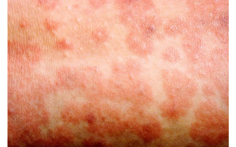 SI at risk of measles outbreak, as cases in region spike